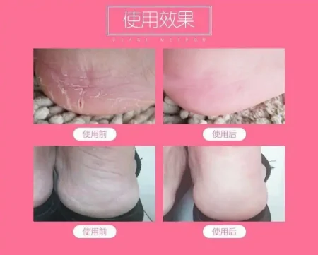 شراب جل سيليكون للعناية وترطيب القدم شراب جل سيليكون للعناية وترطيب القدم